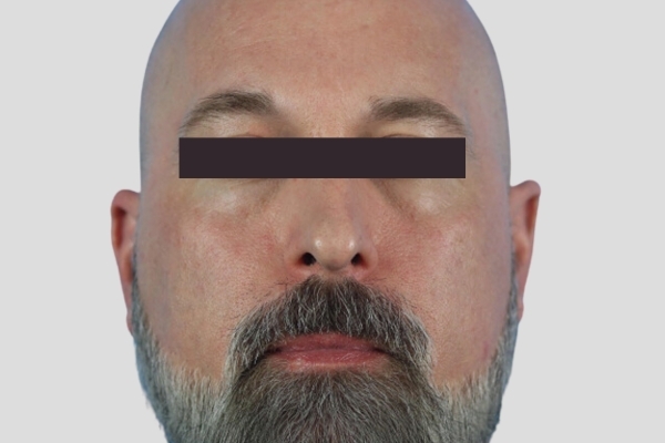 Before treatment: Before and After Dermal Filler - Juvederm Voluma - Cheeks & Midface - Brookfield, WI