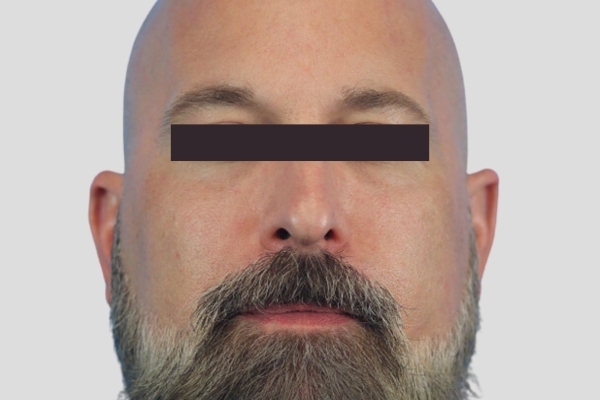After treatment: Before and After Dermal Filler - Juvederm Voluma - Cheeks & Midface - Brookfield, WI