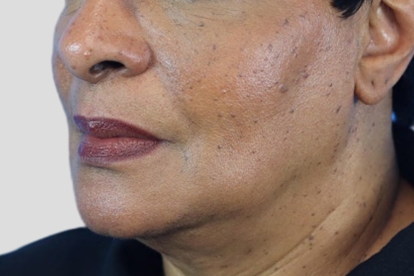 Before treatment: Before and After Dermal Filler - Juvederm Volux - Jawline - Brookfield, WI