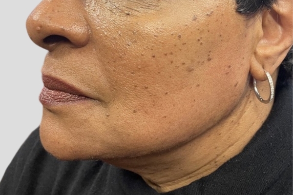 After treatment: Before and After Dermal Filler - Juvederm Volux - Jawline - Brookfield, WI