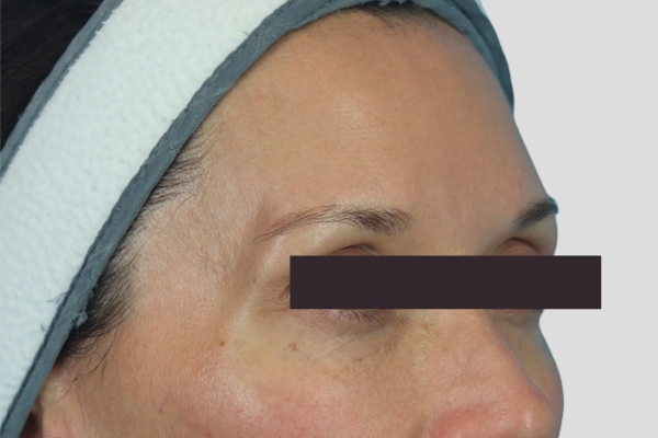 Before treatment: Before and After Dermal Filler - Juvederm Voluma - Temples - Brookfield, Wisconsin
