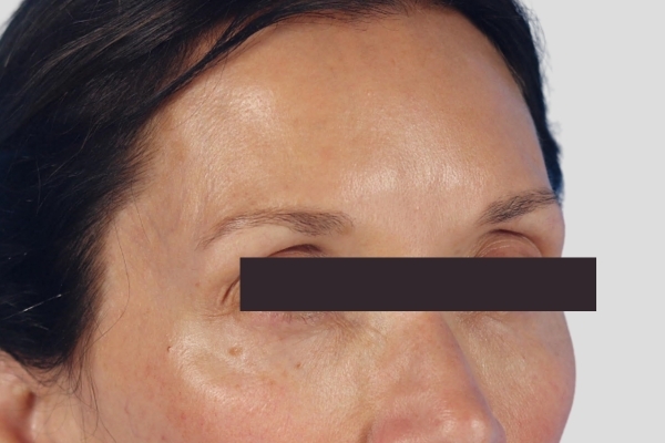 After treatment: Before and After Dermal Filler - Juvederm Voluma - Temples - Brookfield, Wisconsin