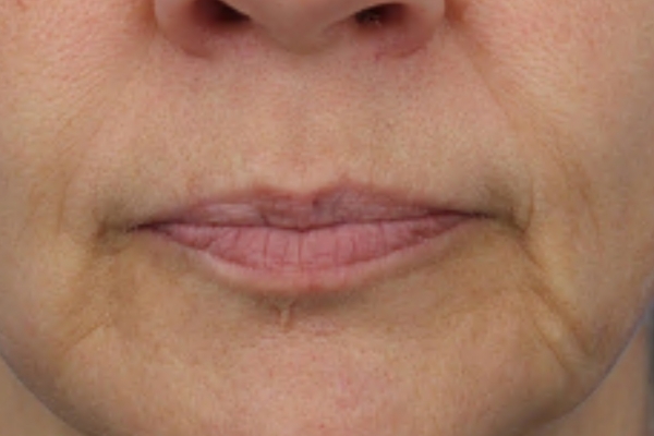 Before treatment: Before and After Dermal Filler - Juvederm Voluma - Marionette Lines - Waukesha WI
