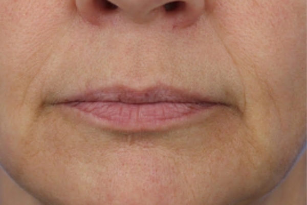 After treatment: Before and After Dermal Filler - Juvederm Voluma - Marionette Lines - Waukesha WI