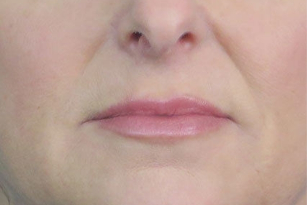 After treatment: Before and After Dermal Filler - Marionette Lines - Juvederm Vollure -  Brookfield WI