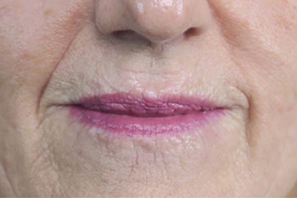 After treatment: 
