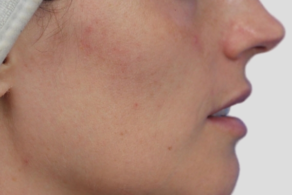 After treatment: Before and after Clarifying HydraFacial - 1 HydraFacial – Brookfield WI