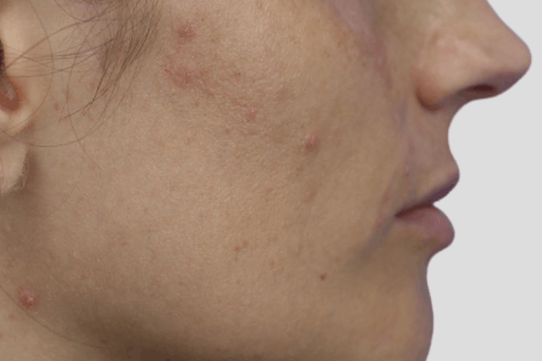 Before treatment: Before and after Clarifying HydraFacial - 1 HydraFacial – Brookfield WI