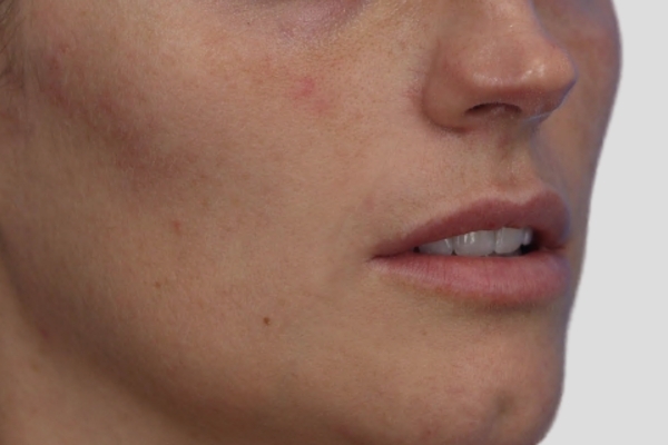 After treatment: Before and after Clarifying HydraFacial - 1 HydraFacial – Delafield WI