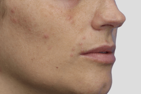 Before treatment: Before and after Clarifying HydraFacial - 1 HydraFacial – Delafield WI