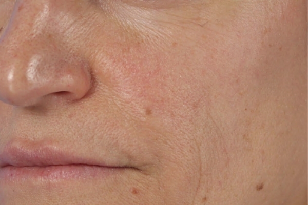 Before treatment: Before and After HydraFacial Dermaplane Radiofrequency- 1 HDR Treatment – Brookfield WI
