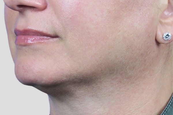 After treatment: Before and After Kybella Fat Dissolving Injections - Front View - Milwaukee, WI