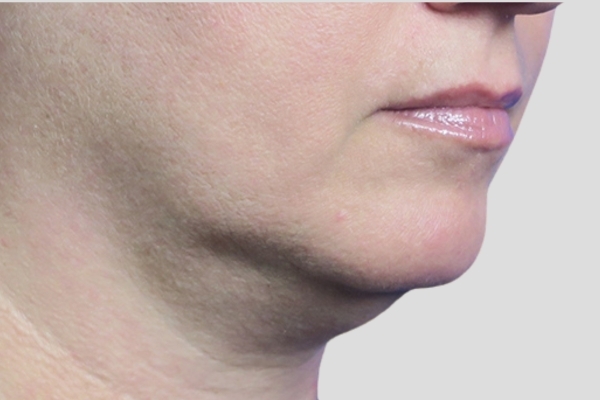 Before treatment: Before and After Kybella Fat Dissolving Injections - Front View - Brookfield, WI
