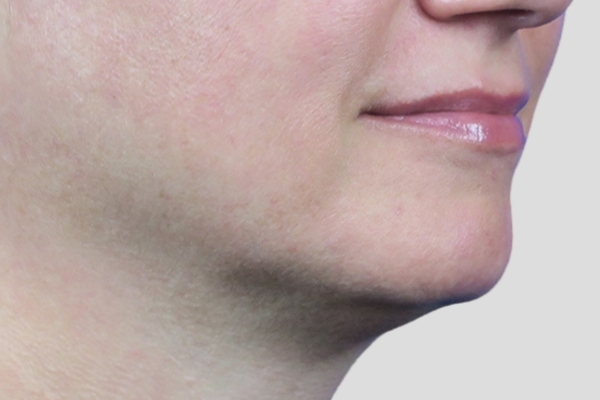 After treatment: Before and After Kybella Fat Dissolving Injections - Front View - Brookfield, WI