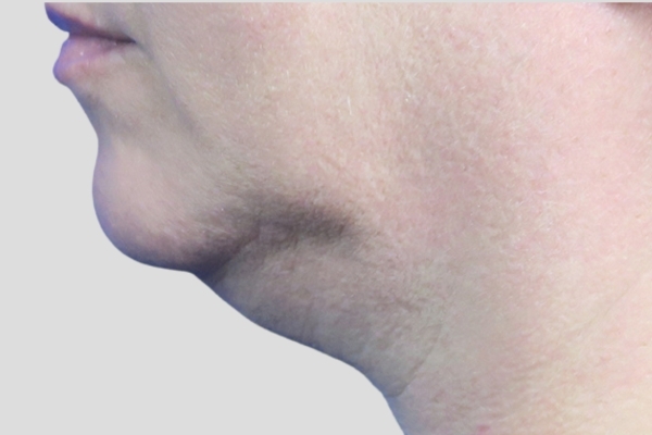 Before treatment: Before and After Kybella Fat Dissolving Injections - Side View - Brookfield, WI
