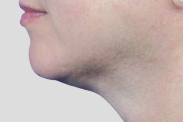 After treatment: Before and After Kybella Fat Dissolving Injections - Side View - Brookfield, WI