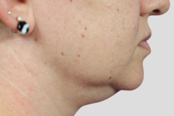 Before treatment: Before and After Kybella Fat Dissolving Injections - Side View - Milwaukee, WI