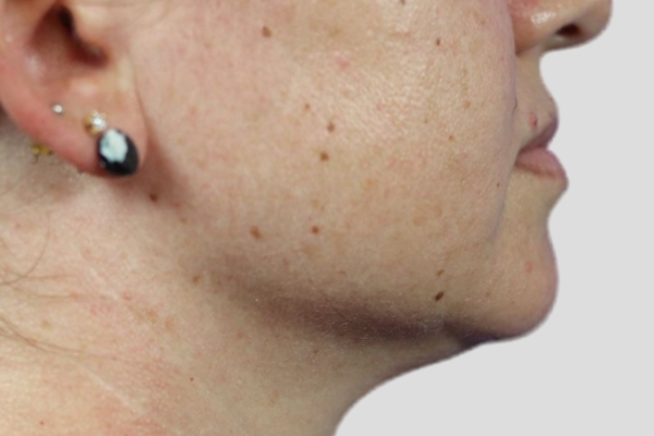 After treatment: Before and After Kybella Fat Dissolving Injections - Side View - Milwaukee, WI