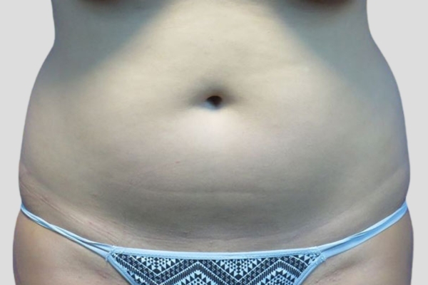 Before treatment: Abdomen Liposuction Brookfield