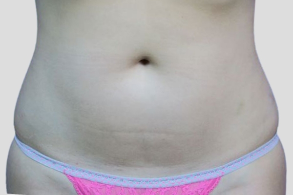 After treatment: Abdomen Liposuction Brookfield