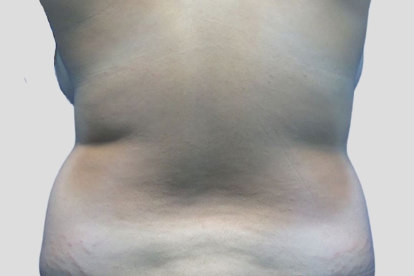 Before treatment: Flanks Liposuction Wauwatosa