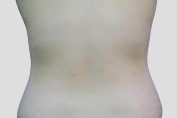 After treatment: Flanks Liposuction Wauwatosa