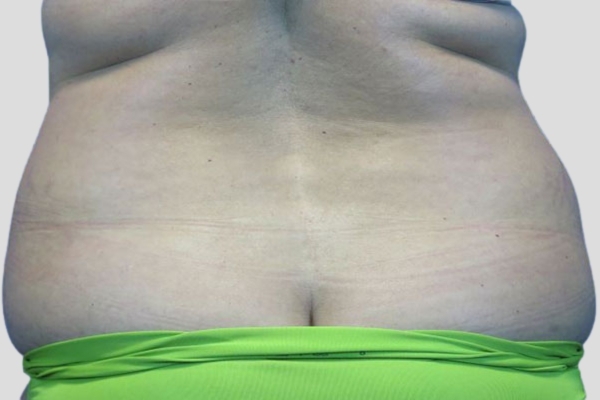 Before treatment: Liposuction Menomonee Falls