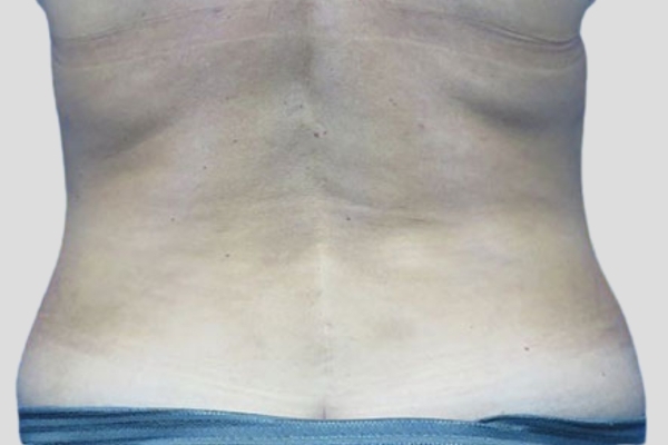 After treatment: Liposuction Menomonee Falls