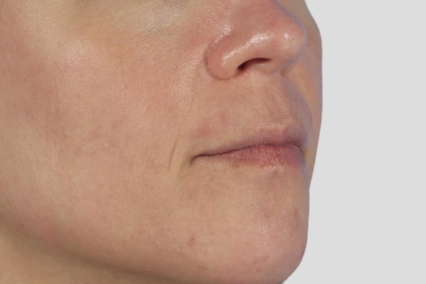 After treatment: Before and after MOXI Laser - 3 MOXI Treatments -  Waukesha WI