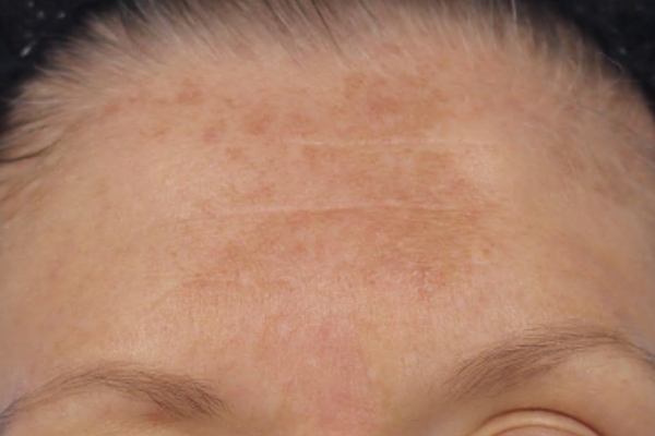 Before treatment: Before and after MOXI Laser - 3 MOXI Treatments -  Pewaukee  WI
