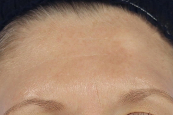 After treatment: Before and after MOXI Laser - 3 MOXI Treatments -  Pewaukee  WI