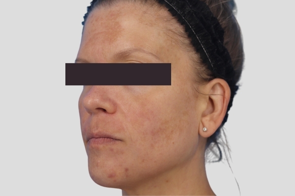 Before treatment: Before and after MOXI Laser - 3 MOXI Treatments -  Brookfield WI