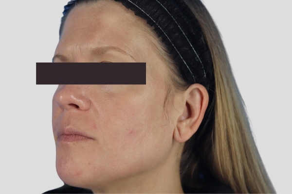 After treatment: Before and after MOXI Laser - 3 MOXI Treatments -  Brookfield WI