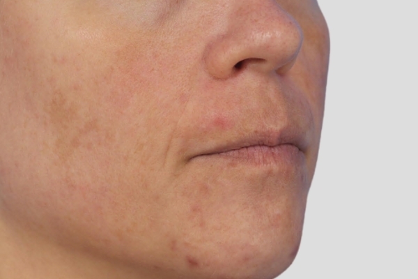 Before treatment: Before and after MOXI Laser - 3 MOXI Treatments -  Waukesha WI