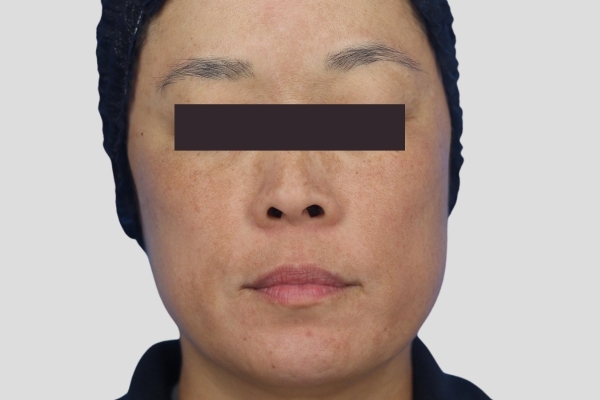 After treatment: Before and after MOXI Laser - Melasma - 3 MOXI Treatments -  Brookfield WI