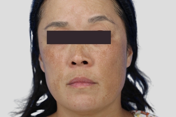 Before treatment: Before and after MOXI Laser - Melasma - 3 MOXI Treatments -  Brookfield WI