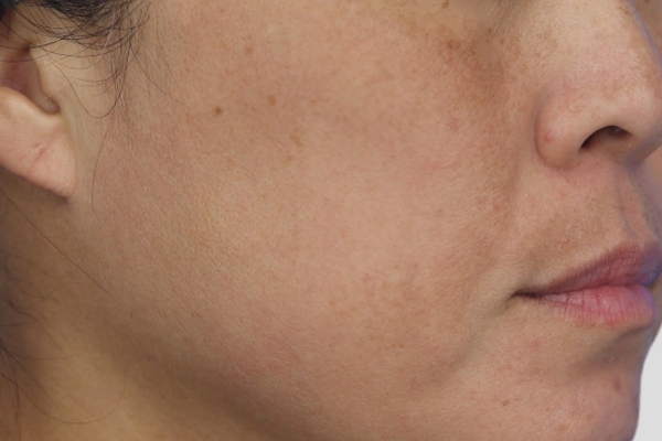 After treatment: Before and after MOXI Laser - Melasma - 2 MOXI Treatments -  Delafield WI