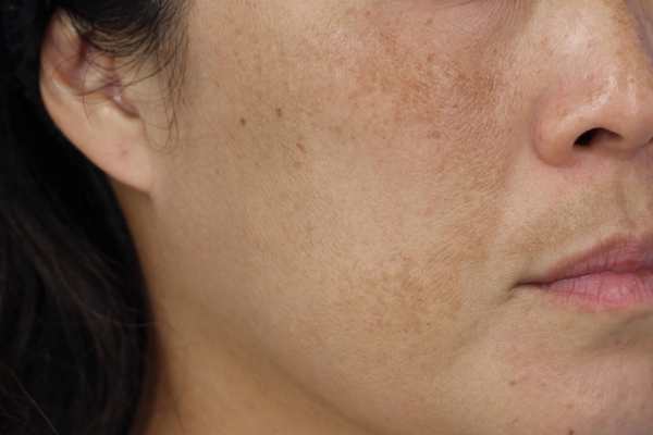 Before treatment: Before and after MOXI Laser - Melasma - 2 MOXI Treatments -  Delafield WI