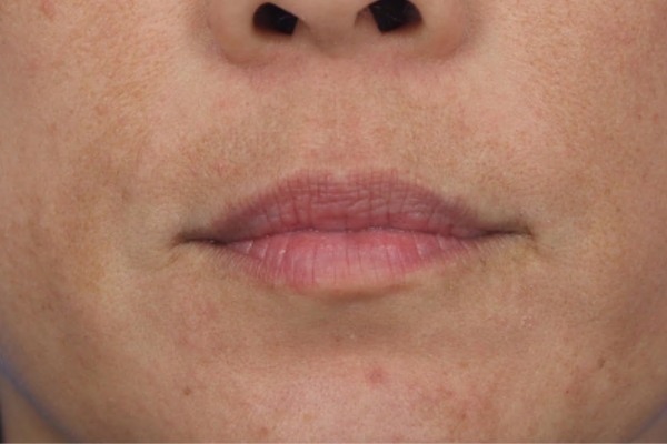 After treatment: Before and after MOXI Laser - Melasma - 3 MOXI Treatments -  Oconomowoc WI