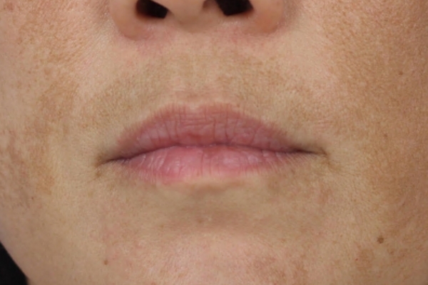 Before treatment: Before and after MOXI Laser - Melasma - 3 MOXI Treatments -  Oconomowoc WI