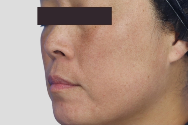 After treatment: Before and after MOXI Laser - Melasma - 2 MOXI Treatments -  Waukesha WI