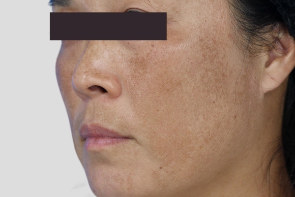 Before treatment: Before and after MOXI Laser - Melasma - 2 MOXI Treatments -  Waukesha WI