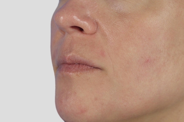 After treatment: Before and after MOXI Laser - Skin Tone & Texture - 3 MOXI Treatments -  Waukesha WI