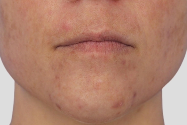 Before treatment: Before and after MOXI Laser - Skin Tone & Texture - 3 MOXI Treatments -  Pewaukee WI