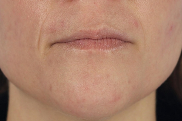 After treatment: Before and after MOXI Laser - Skin Tone & Texture - 3 MOXI Treatments -  Pewaukee WI