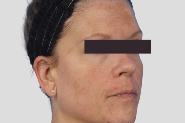 Before treatment: Before and after MOXI Laser - Skin Tone & Texture - 3 MOXI Treatments -  Brookfield WI
