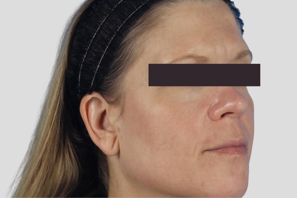 After treatment: Before and after MOXI Laser - Skin Tone & Texture - 3 MOXI Treatments -  Brookfield WI