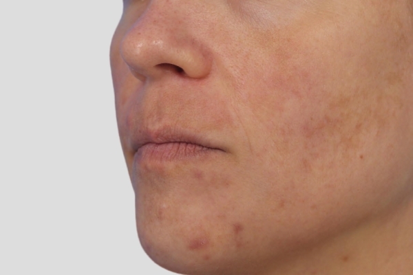 Before treatment: Before and after MOXI Laser - Skin Tone & Texture - 3 MOXI Treatments -  Waukesha WI
