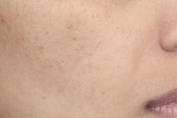 After treatment: Before and after SkinPen Microneedling - 3 Treatments of SkinPen Microneedling and VI Peel – Waukesha WI
