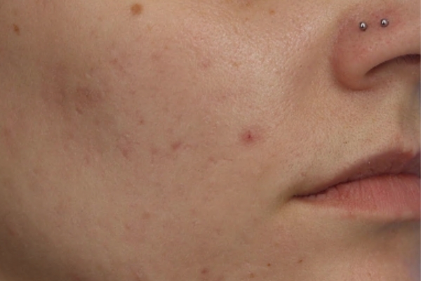 After treatment: Before and after SkinPen Microneedling - 3 Treatments of SkinPen Microneedling – Brookfield WI